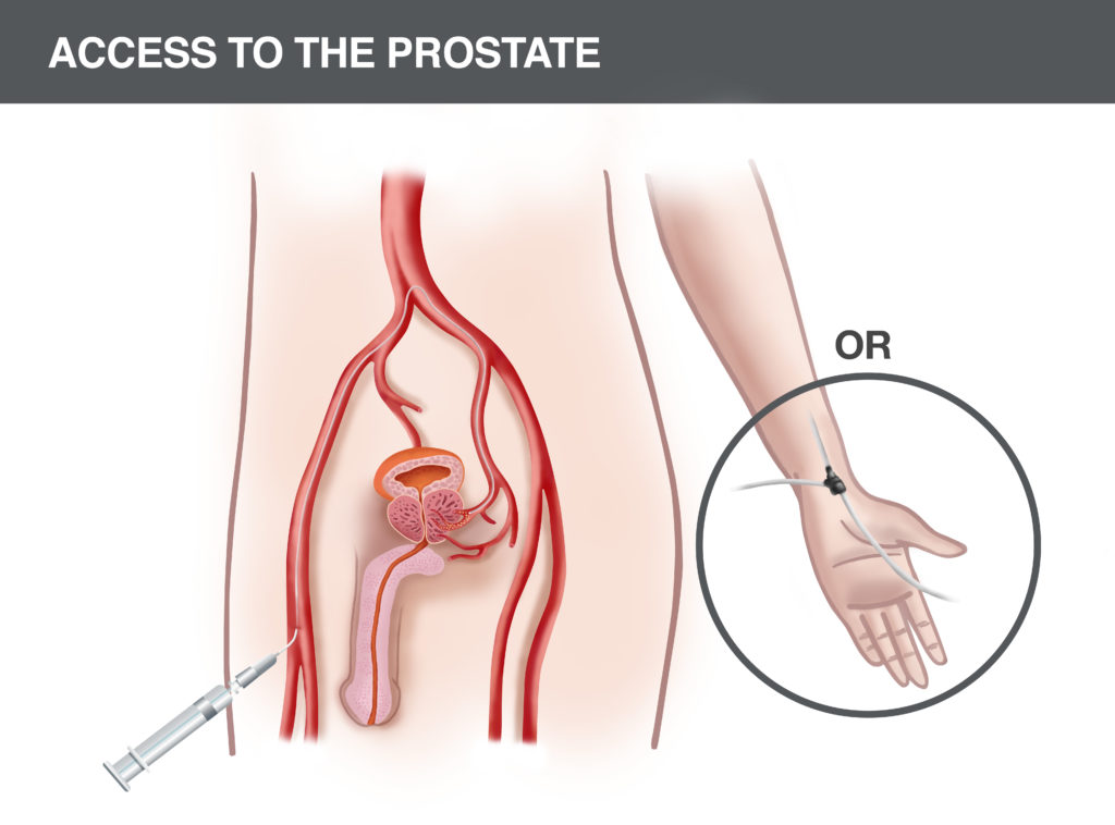 suite opération prostate