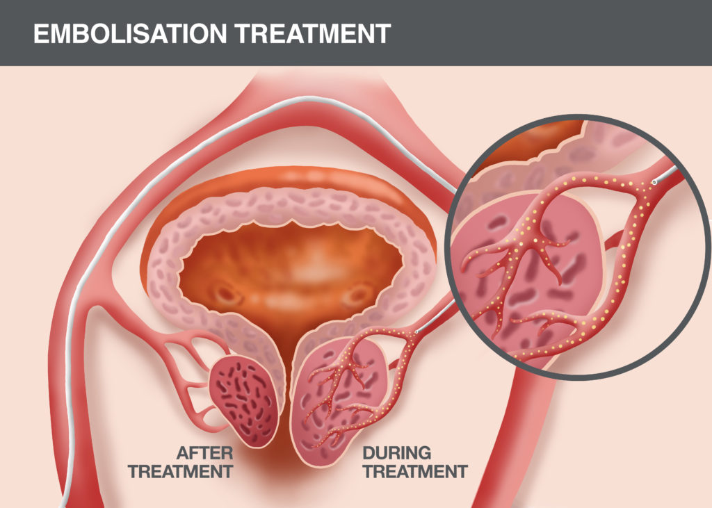 Operation suite papillomavirus - Aggressive cancer of the prostate, Operation suite papillomavirus